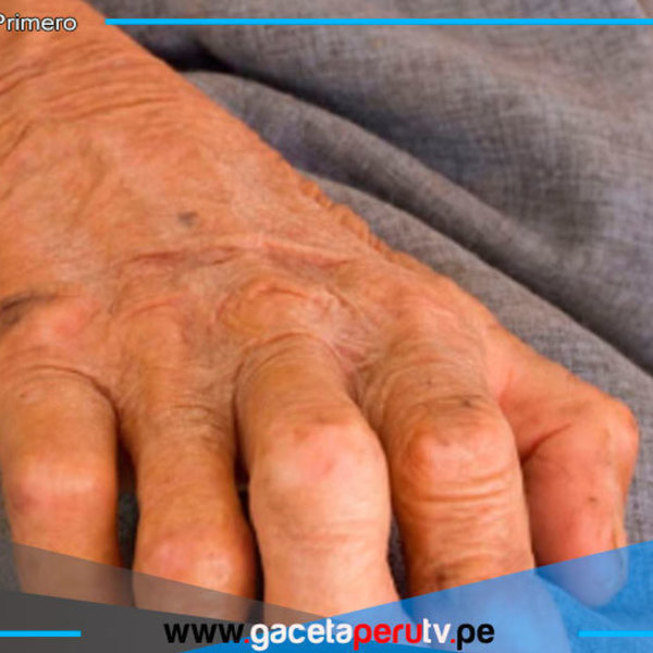 Lepra es curable con tratamiento gratuito, alerta OMS y Minsa