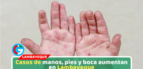 Lambayeque reporta más de 300 casos de manos, pies y boca