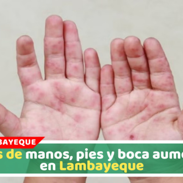 Lambayeque reporta más de 300 casos de manos, pies y boca